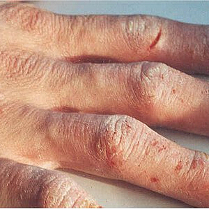 Hauterkrankung Hand
